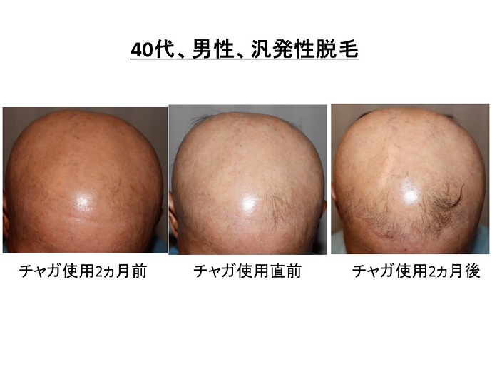 円形脱毛症　病院